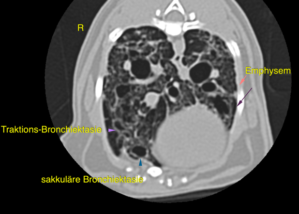 Figure 1 (emphysema, traction bronchiectasis, saccular bronchiectasis)