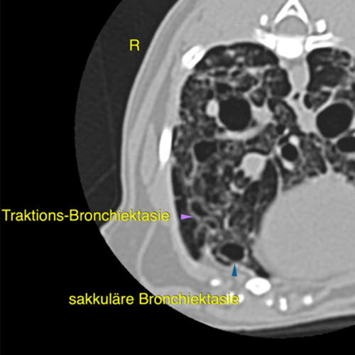 Traction bronchiectasis