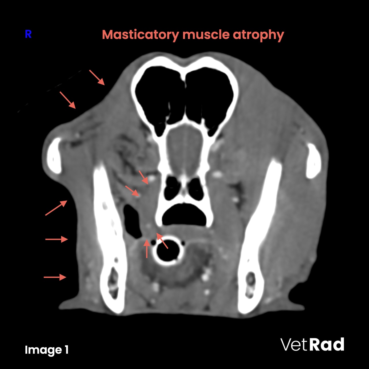 A moderate reduction in size of all right masticatory muscles (M. temporalis, M. masseter, M. pterygoideus medialis et lateralis and M. digastricus) is evident.